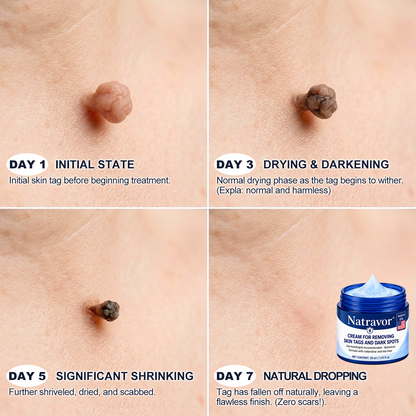 🔥Natravor® 7-𝐃𝐚𝐲 𝐒𝐤𝐢𝐧 𝐓𝐚𝐠 & 𝐒𝐩𝐨𝐭 𝐄𝐫𝐚𝐬𝐞𝐫 𝐂𝐫𝐞𝐚𝐦 (Zero Pain, Zero 𝐒𝐜𝐚𝐫𝐬 Formula) 💎