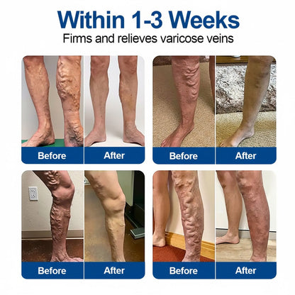 🇺🇸👨‍⚕️✅TAILEDEN® VeinEase Microneedle Care Patch⚡Instant Relief, Long-Term Results