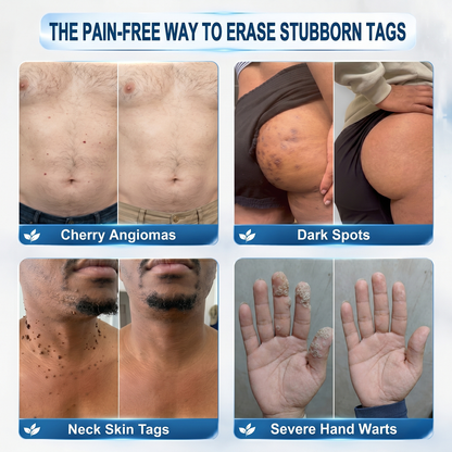 🔥Natravor® 7-𝐃𝐚𝐲 𝐒𝐤𝐢𝐧 𝐓𝐚𝐠 & 𝐒𝐩𝐨𝐭 𝐄𝐫𝐚𝐬𝐞𝐫 𝐂𝐫𝐞𝐚𝐦 (Zero Pain, Zero 𝐒𝐜𝐚𝐫𝐬 Formula) 💎